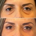 Eyelid BA 4