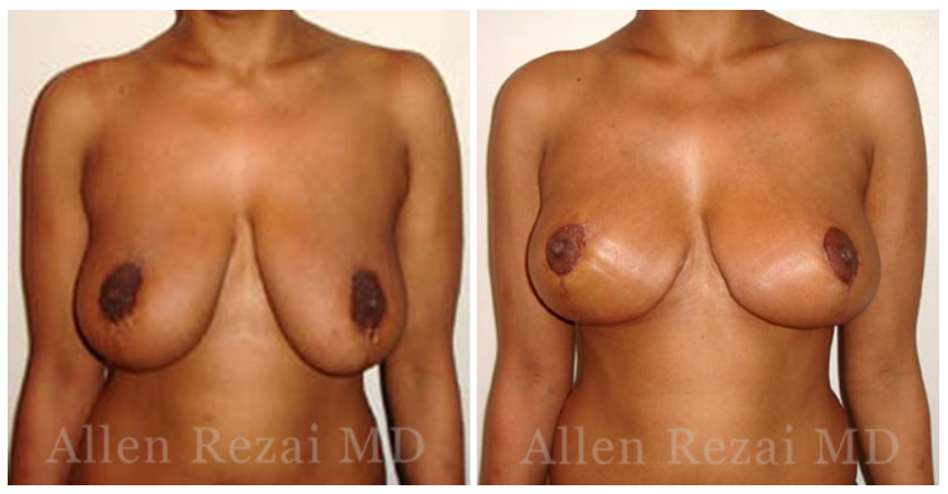 breastuplift1
