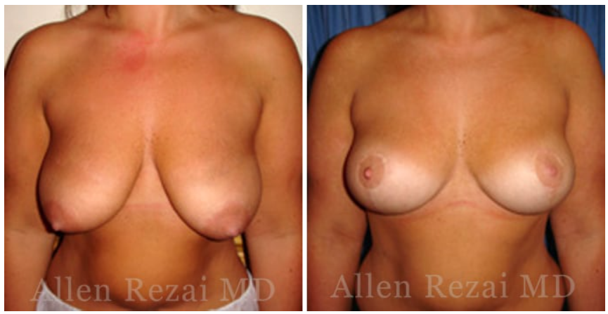 breastuplift2 breastuplift2