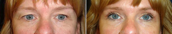 ba1 Upper eyelid surgery